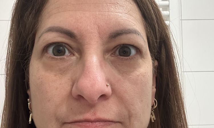 Wellige Haut am Oberlid - 84177