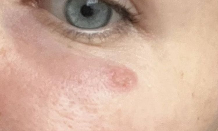 Profhilo ging schief. - 84218