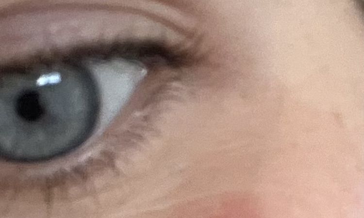 Profhilo ging schief. - 84219