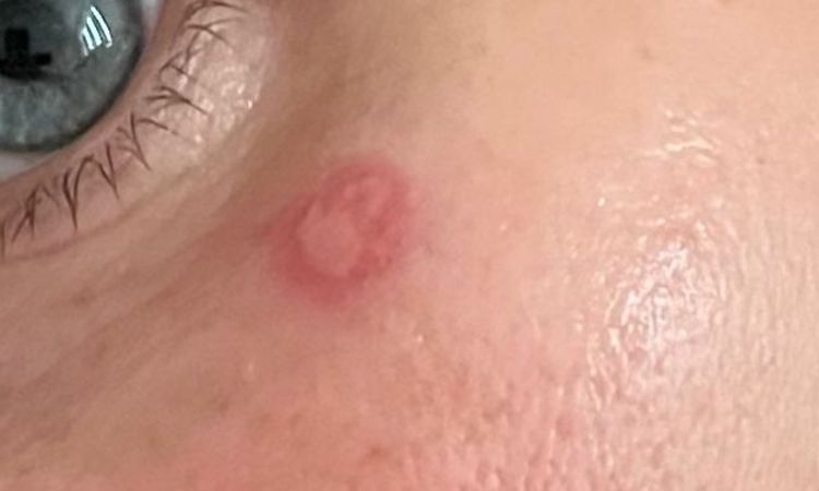 Profhilo ging schief. - 84220