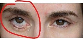 Narbe zieht Unterlid nach unten - 84239