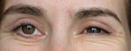 Narbe zieht Unterlid nach unten - 84240