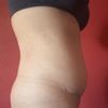 Großer Kugelbauch 14 Wochen nach Bauchdeckenstraffung