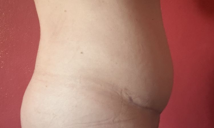 Großer Kugelbauch 14 Wochen nach Bauchdeckenstraffung - 84256