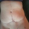 Großer Kugelbauch 14 Wochen nach Bauchdeckenstraffung