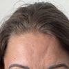 Tiefe Dellen nach Botoxbehandlung