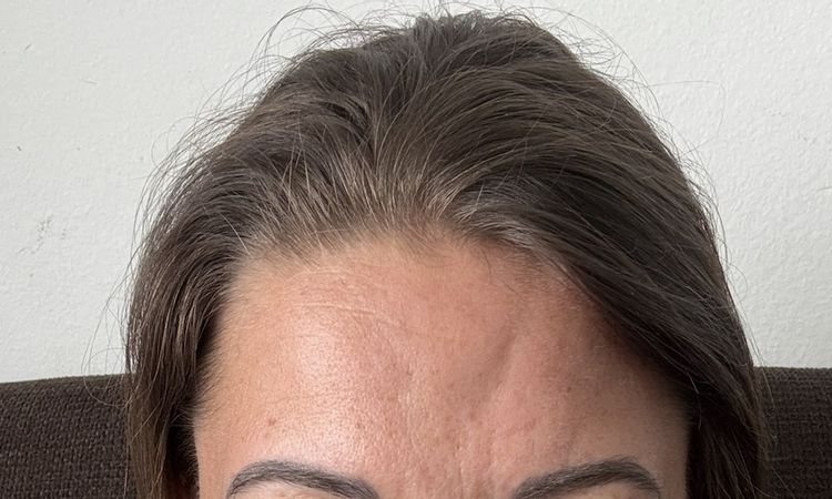 Tiefe Dellen nach Botoxbehandlung - 84267