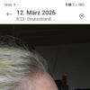 5 Monate nach Deep Plan Facelift sehr unschöne Flecken, links wie rechts.