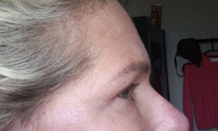 5 Monate nach Deep Plan Facelift sehr unschöne Flecken, links wie rechts. - 84296