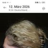 5 Monate nach Deep Plan Facelift sehr unschöne Flecken, links wie rechts.