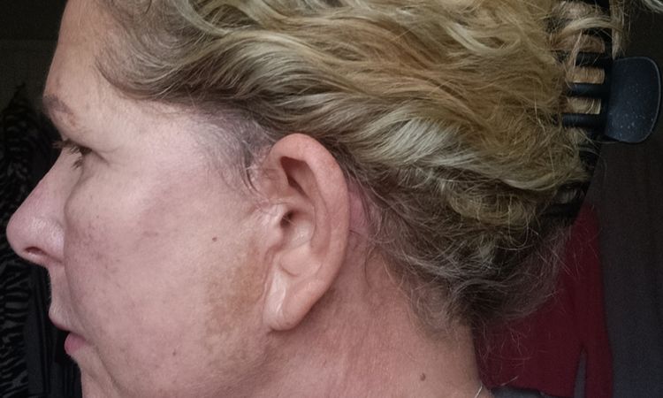 5 Monate nach Deep Plan Facelift sehr unschöne Flecken, links wie rechts. - 84297