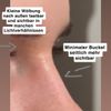 Hylauron nachkorrektur berechtigt?