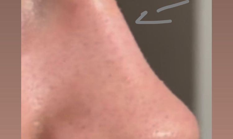 Hylauron nachkorrektur berechtigt? - 84304