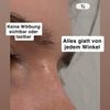 Hylauron nachkorrektur berechtigt?
