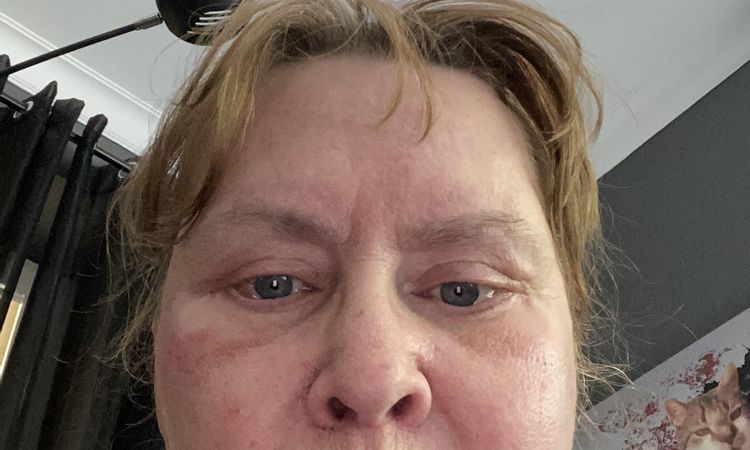 Lippe verunstaltet nach Bullhornlift - 84344