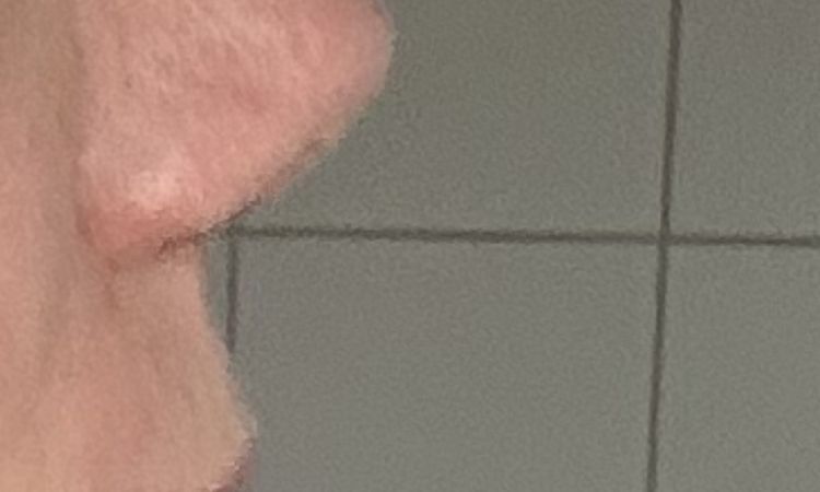 Nase sehr spitz nach Revision - 84357
