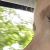 Nase sehr spitz nach Revision