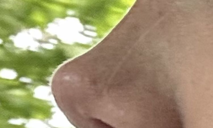 Nase sehr spitz nach Revision - 84358