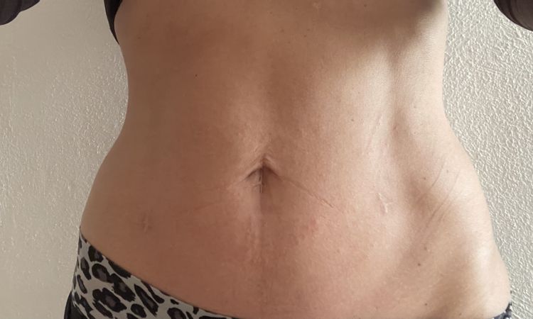 Radiofrequenz needling am bauch - 84360