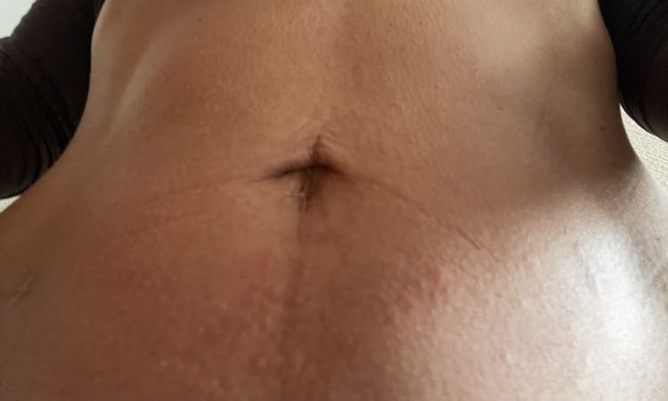 Radiofrequenz needling am bauch - 84361