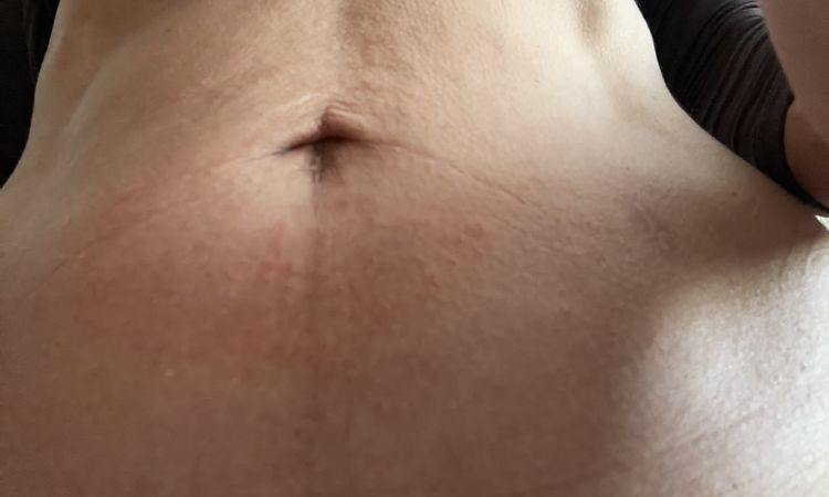 Radiofrequenz needling am bauch - 84362