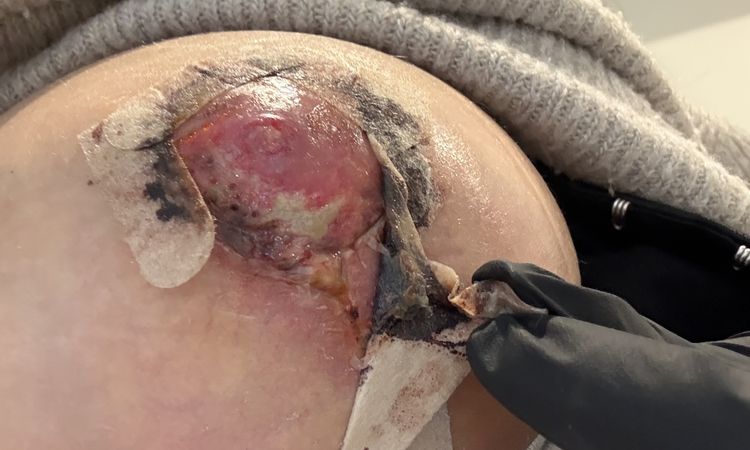 Nekrose und Wundheilungsstörung nach Bruststtaffung - 84367