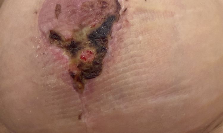 Nekrose und Wundheilungsstörung nach Bruststtaffung - 84368