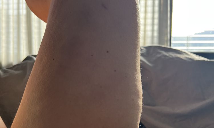 Beule nach Liposuktion, 3,5 Monate post OP - 84403