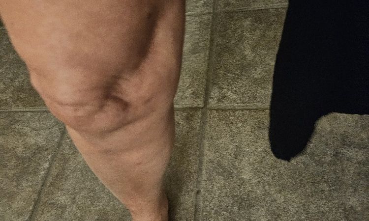 Korrektur an Knien nach zu aggressiver Fettabsaugung - 84427
