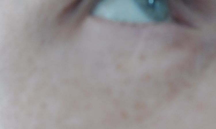 Lymphstau nach botox - 84435