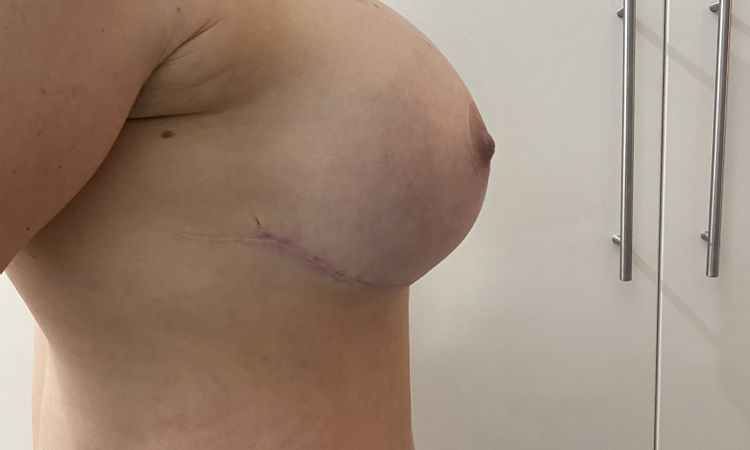 Anhaltende Schwellung 15 Wochen nach Revision - 84458