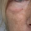 Schwellungen nach Mide Face Operation -Malar bags