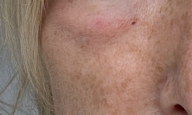 Schwellungen nach Mide Face Operation -Malar bags - 84484