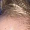 Weisse Breite Narbe bei Kind