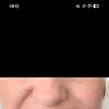 Botox in den DLI gewandert