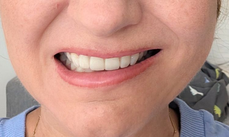 Botox in den DLI gewandert - 84536