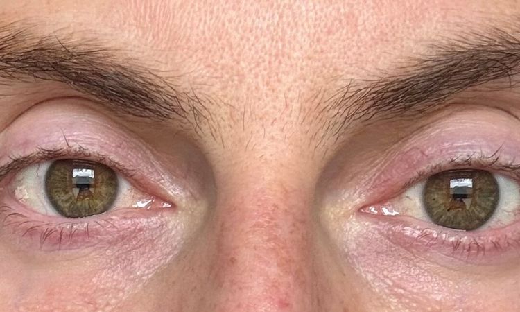 Lipofilling - Hohlauge Volumenaufbau mit Eigenfett - 84555