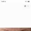 Nach Unterlid Unterlid Straffung eine Auge kleiner
