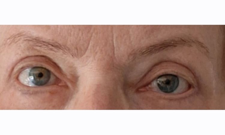 Nach Unterlid Unterlid Straffung eine Auge kleiner - 84556