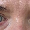 Chemosis nach UnterlidOp