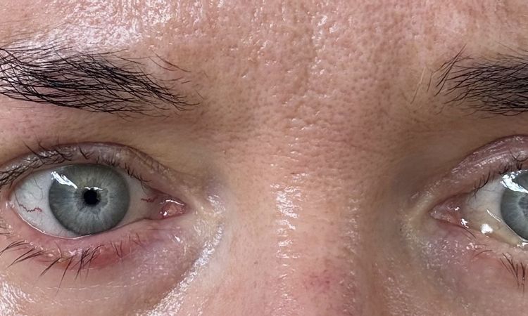 Chemosis nach UnterlidOp - 84571