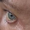 Chemosis nach UnterlidOp