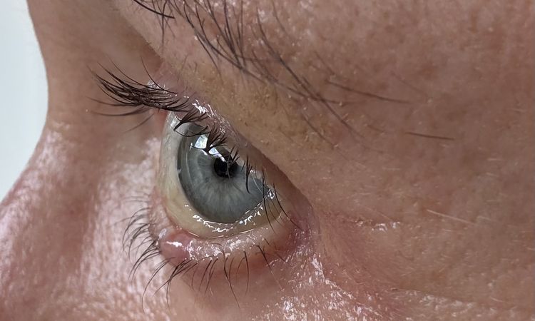 Chemosis nach UnterlidOp - 84572