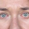 Chemosis nach UnterlidOp