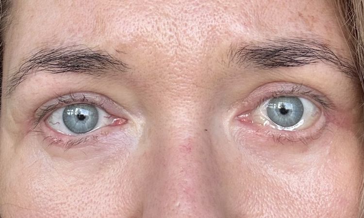 Chemosis nach UnterlidOp - 84573