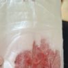 Nachblutung 9Tage nach Bauchdeckenstraffung mit Liposuktion