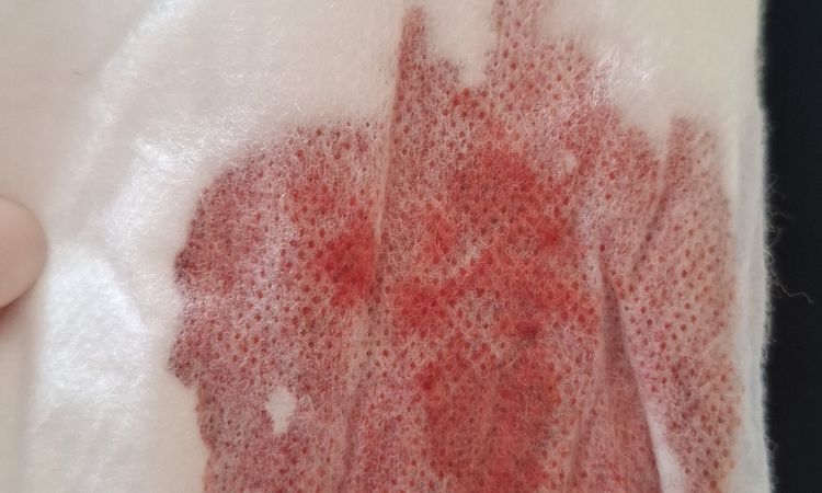 Nachblutung 9Tage nach Bauchdeckenstraffung mit Liposuktion - 84574