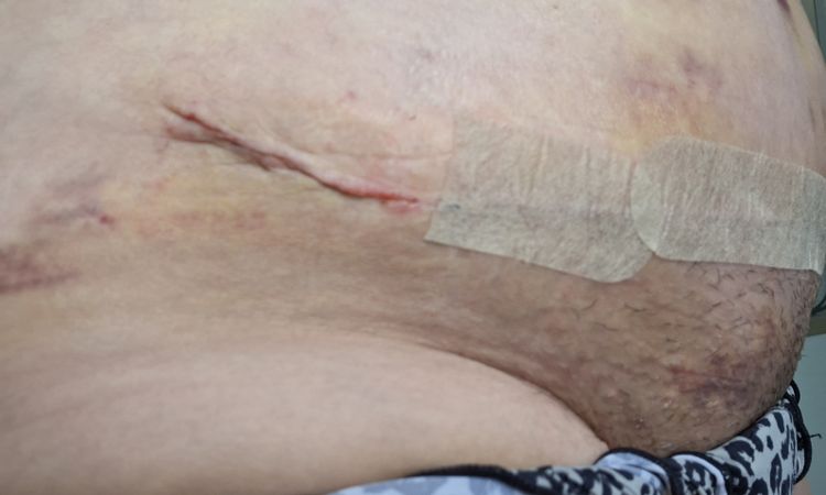 Nachblutung 9Tage nach Bauchdeckenstraffung mit Liposuktion - 84575