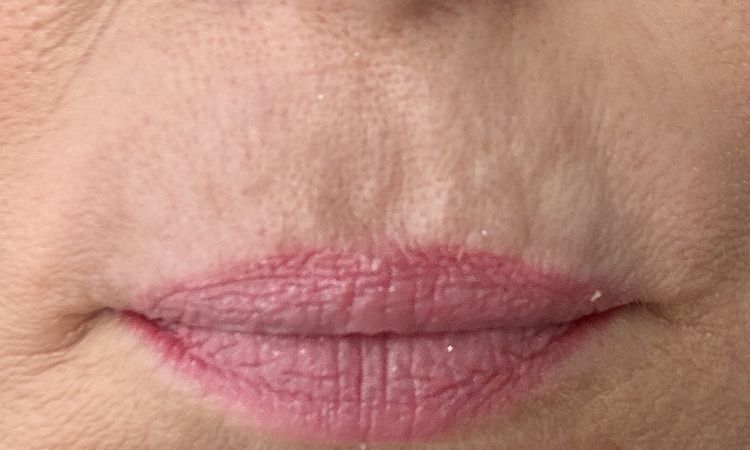 Unterspritzung Raucherfältchen - 84612