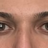 Hallo, ich hatte vor 19 Tagen eine Septorhinoplastik.